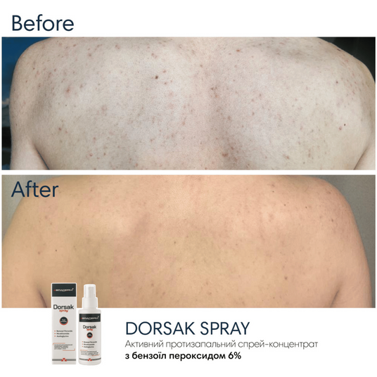 Спрей для тіла з бензоїл пероксидом Braderm Dorsak Spray, 100 мл 10739 фото