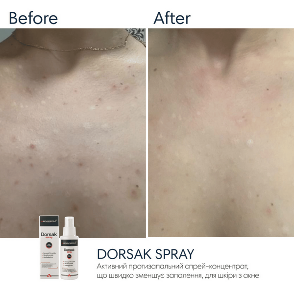 Спрей для тіла з бензоїл пероксидом Braderm Dorsak Spray, 100 мл 10739 фото