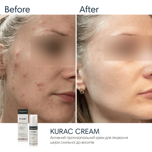 Крем з бензоїл пероксидом Braderm Kurac Cream, 30 мл 10740 фото