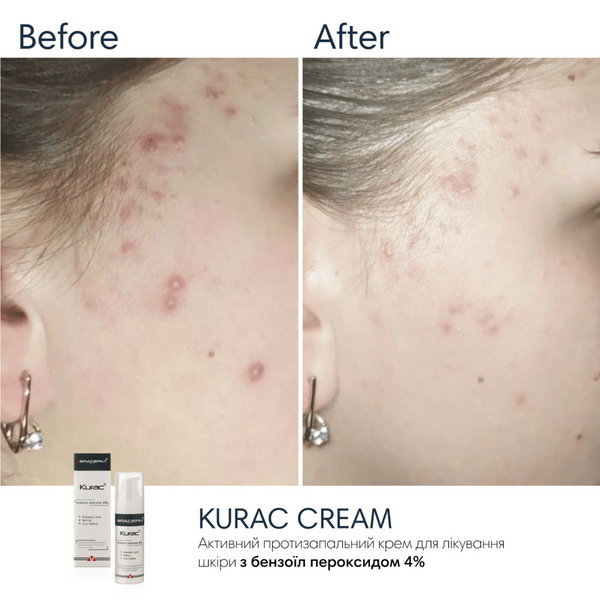 Крем з бензоїл пероксидом Braderm Kurac Cream, 30 мл 10740 фото