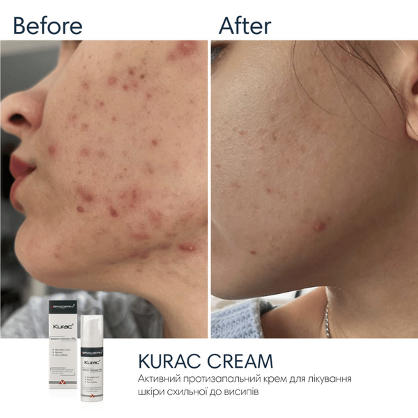 Крем з бензоїл пероксидом Braderm Kurac Cream, 30 мл 10740 фото