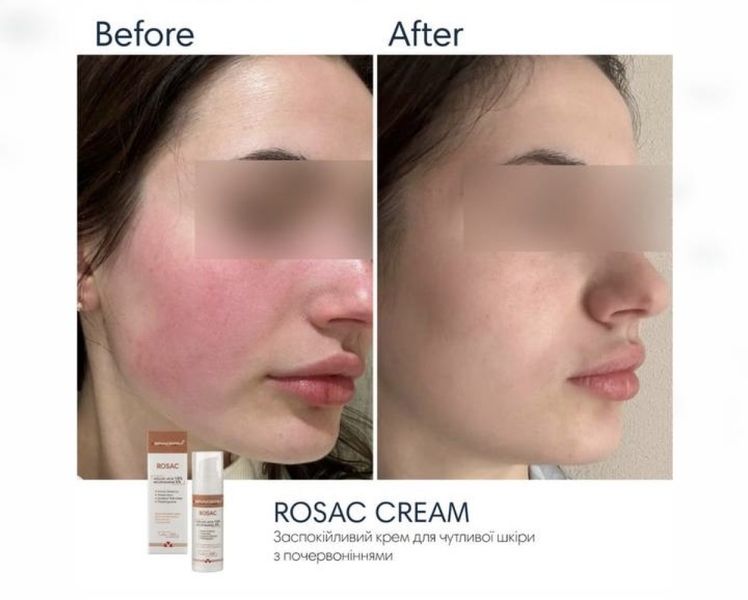 Крем з азелаїновою кислотою Braderm Rosac Cream, 30 мл 10742 фото